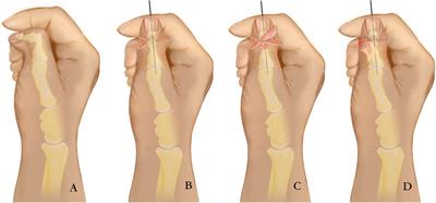 Reconstruction of radial deviation after preaxial polydactyly surgery: use of an ulnar fascial flap